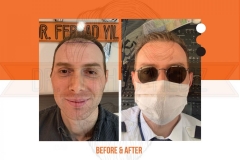 Hair Transplant Before After