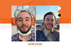 Hair Transplant Before After