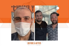 Hair Transplant Before After