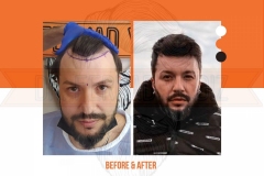 Hair Transplant Before After