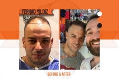 Hair Transplant Before After