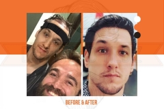 Hair Transplant Before After