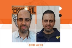 Hair Transplant Before After