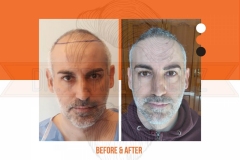 Hair Transplant Before After