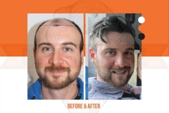 Hair Transplant Before After