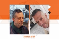 Hair Transplant Before After