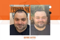 Hair Transplant Before After