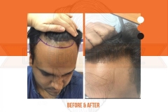 Hair Transplant Before After