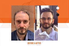 Hair Transplant Before After