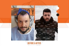 Hair Transplant Before After