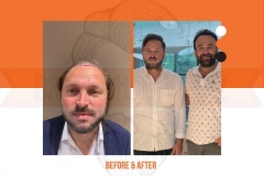 Hair Transplant Before After