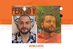 Hair Transplant Before After