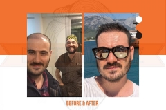 Hair Transplant Before After