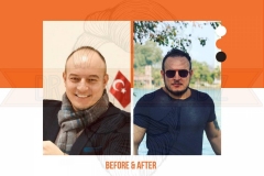 Hair Transplant Before After 2022