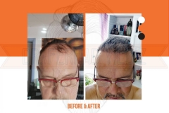 Hair Transplant Before After 2022