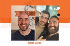 Hair Transplant Before After 2022