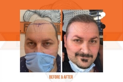 Hair Transplant Before After 2022