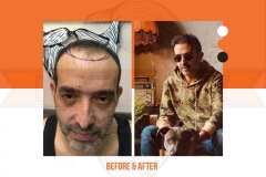 Hair Transplant Before After 2022