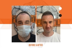 Hair Transplant Before After 2022