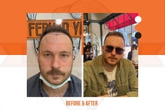 Hair Transplant Before After 2022