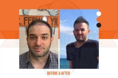 Hair Transplant Before After 2022