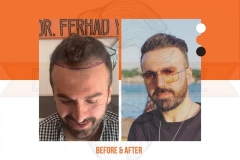 Hair Transplant Before After 2022