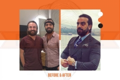 Hair Transplant Before After 2022