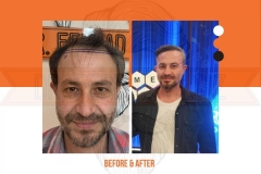 Hair Transplant Before After 2022