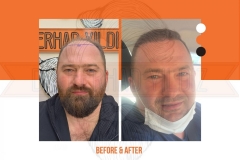 Hair Transplant Before After 2022