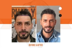 Hair Transplant Before After 2022