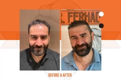 Hair Transplant Before After 2022