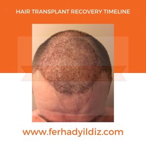 Hair Transplant Timeline 10