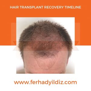 Hair Transplant Timeline 12