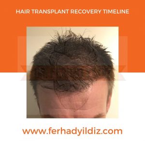 Hair Transplant Timeline 16