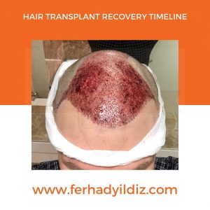 Hair Transplant Timeline 2