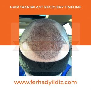 Hair Transplant Recovery Timeline 3