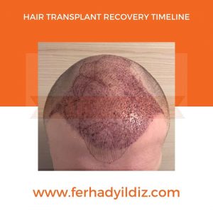 Hair Transplant Timeline 4