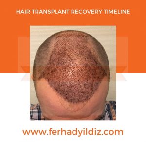 Hair transplant after 2 weeks - What to expect - KSL Clinic