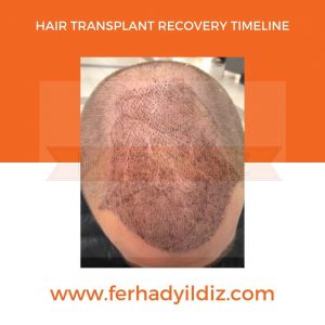 Hair Transplant Timeline 8